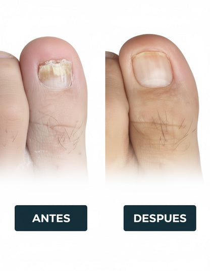 MEDINAIL - SPRAY PARA HOMGOS DEL PIEL